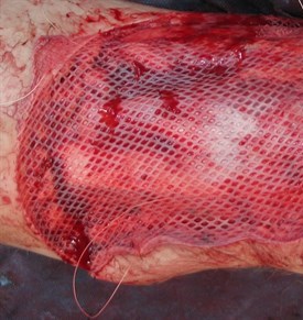  Split Skin Grafting