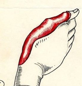 Hand scar revision and Split Skin Graft