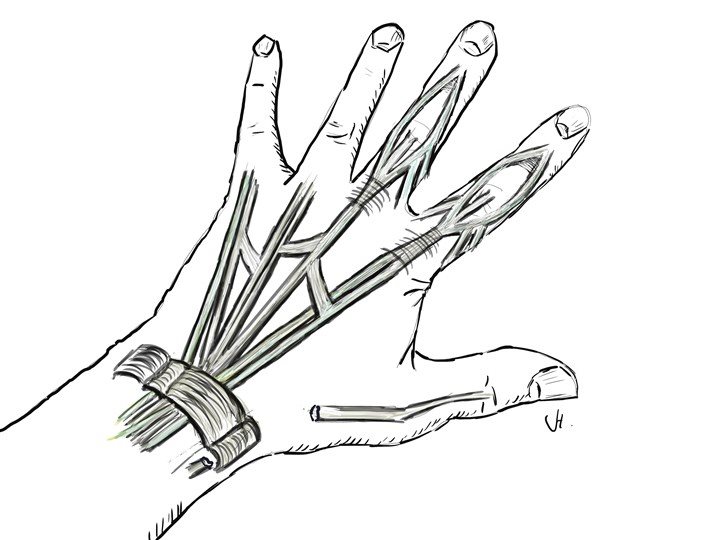 Tendon Transfer 