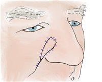 V to Y flap. Inset and suture of flap