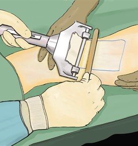  What is a Split Skin Graft?