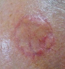  What is a Full Thickness Skin Graft?