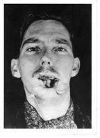 Before reconstruction. Anterior view.