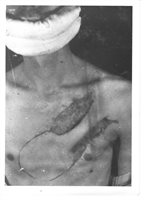 Tube pedicle being raised, and 