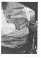 After pedicle division and partial retun to skin grafted donor site.