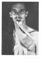 Tube pedicle transferred and inset. Pedicle blood supply maintained. Donor site skin grafted.