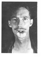 Initial inset of healed flap, before thinning and re-shaping.