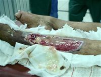 An infected open lower limb fracture 
