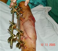 Local flap cover of an open fracture